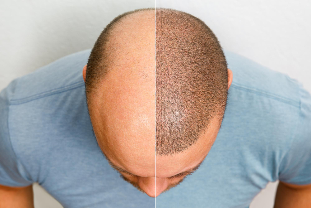 head-balding-man-before-after-hair-transplant-surgery-man-losing-his-hair-has-become-shaggy-advertising-poster-hair-transplant-clinic-treatment-baldness head-balding-man-before-after-hair-transplant-surgery-man-losing-his-hair-has-become-shaggy-advertising-poster-hair-transplant-clinic-treatment-baldness